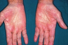 Avuç İçinde Kızarıklık Belirtileri ve Tedavisi