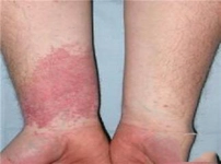 Deride Kızarıklık Belirtileri ve Tedavisi