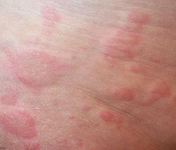 Kaşıntılı Kızarıklık Belirtileri ve Tedavisi