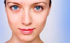 Sivilce Kızarıklığı Belirtileri ve Tedavisi