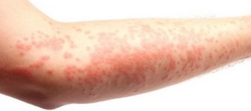 Vücutta Kızarıklık Belirtileri ve Tedavisi